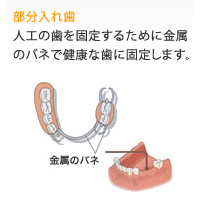部分入れ歯
人工の歯を固定するために金属のバネで健康な歯に固定します。
