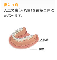 総入れ歯
人工の歯（入れ歯）を歯茎全体にかぶせます。